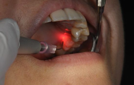 Are Laser Dental Procedures Better Than Traditional Treatments? – Stavya  Dental Clinic