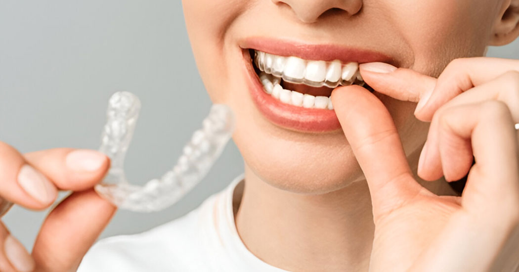 Invisible Braces