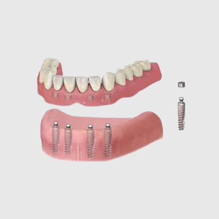 Removable Partial and Complete Dentures