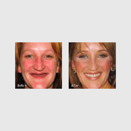 Removable Partial and Complete Dentures