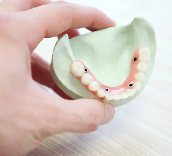 Dental Implants
