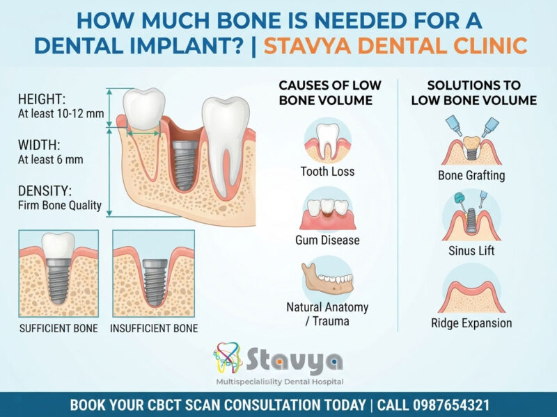 How Much Bone Is Needed for a Dental Implant?