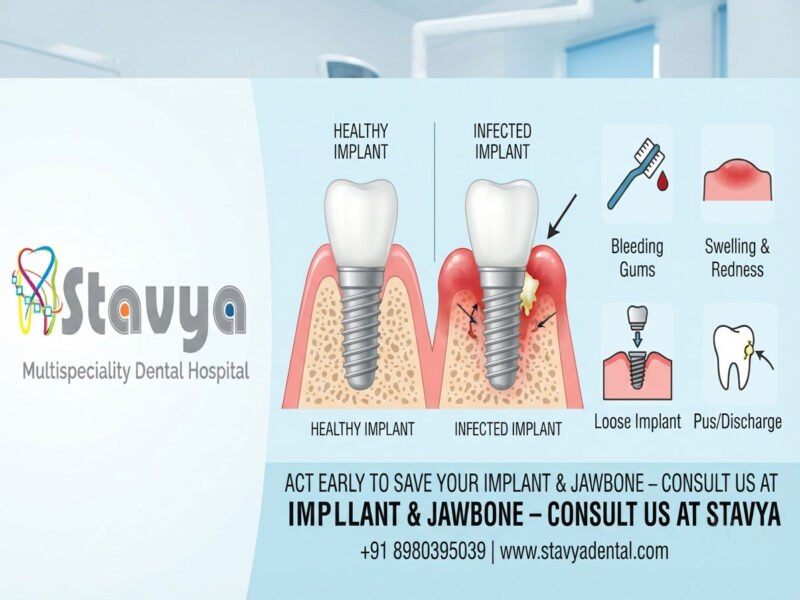 Dental Implant Infection: Warning Signs You Should Never Ignore