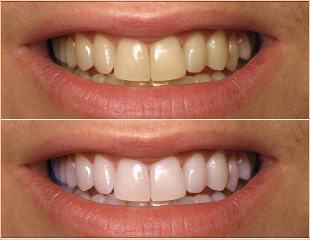 Bleaching/whitening