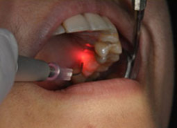 Dental Laser